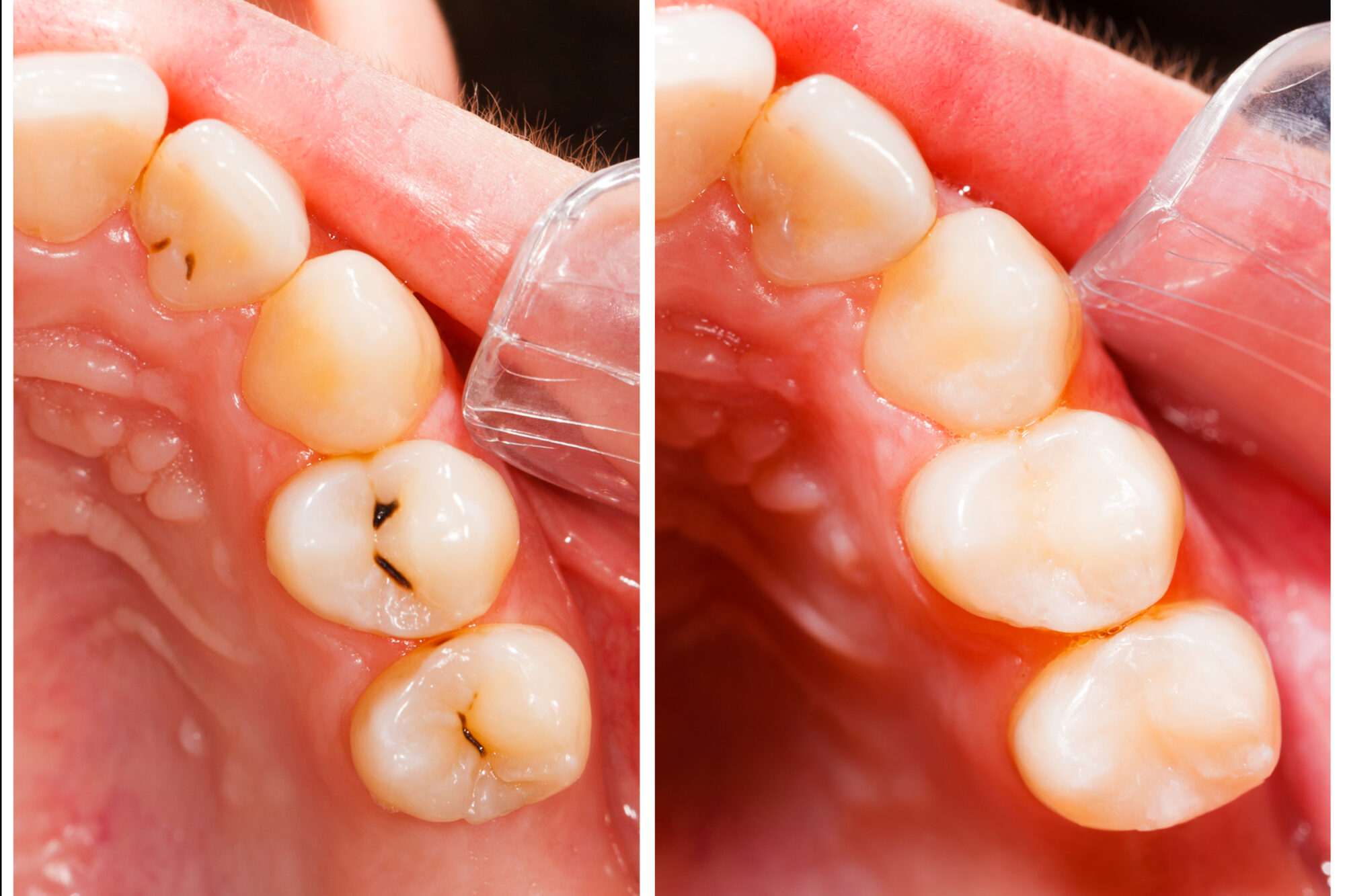 Teeth,Before,And,After,Treatment,-,Dental,Composite,Filling.