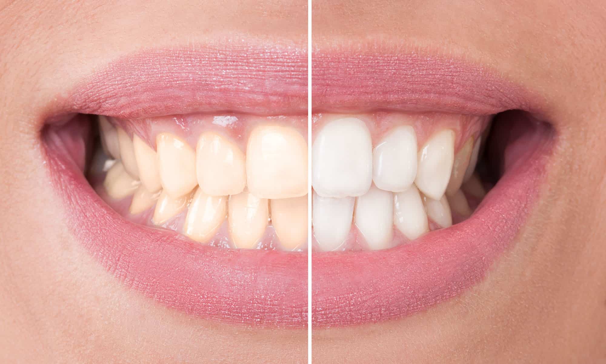 Perfect,Smile,Before,And,After,Bleaching.,Dental,Care,And,Whitening Perfect smile before and after bleaching. Dental care and whitening concept